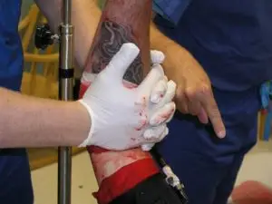 Clamshell direct pressure is applied to a forearm arterial laceration with complete cessation of blood flow.