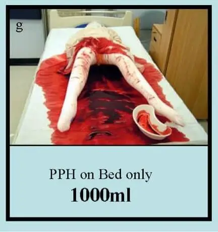A dummy laying on a bed simulating blood loss after childbirth of 1000 ml, the fake blood is soaked into the sheets
