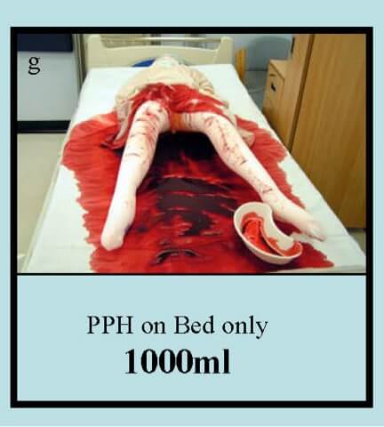 A dummy laying on a bed simulating blood loss after childbirth of 1000 ml, the fake blood is soaked into the sheets