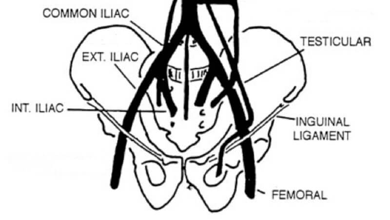 a diagram of the pelvis showing the major vasculature including the iliac / femoral artery