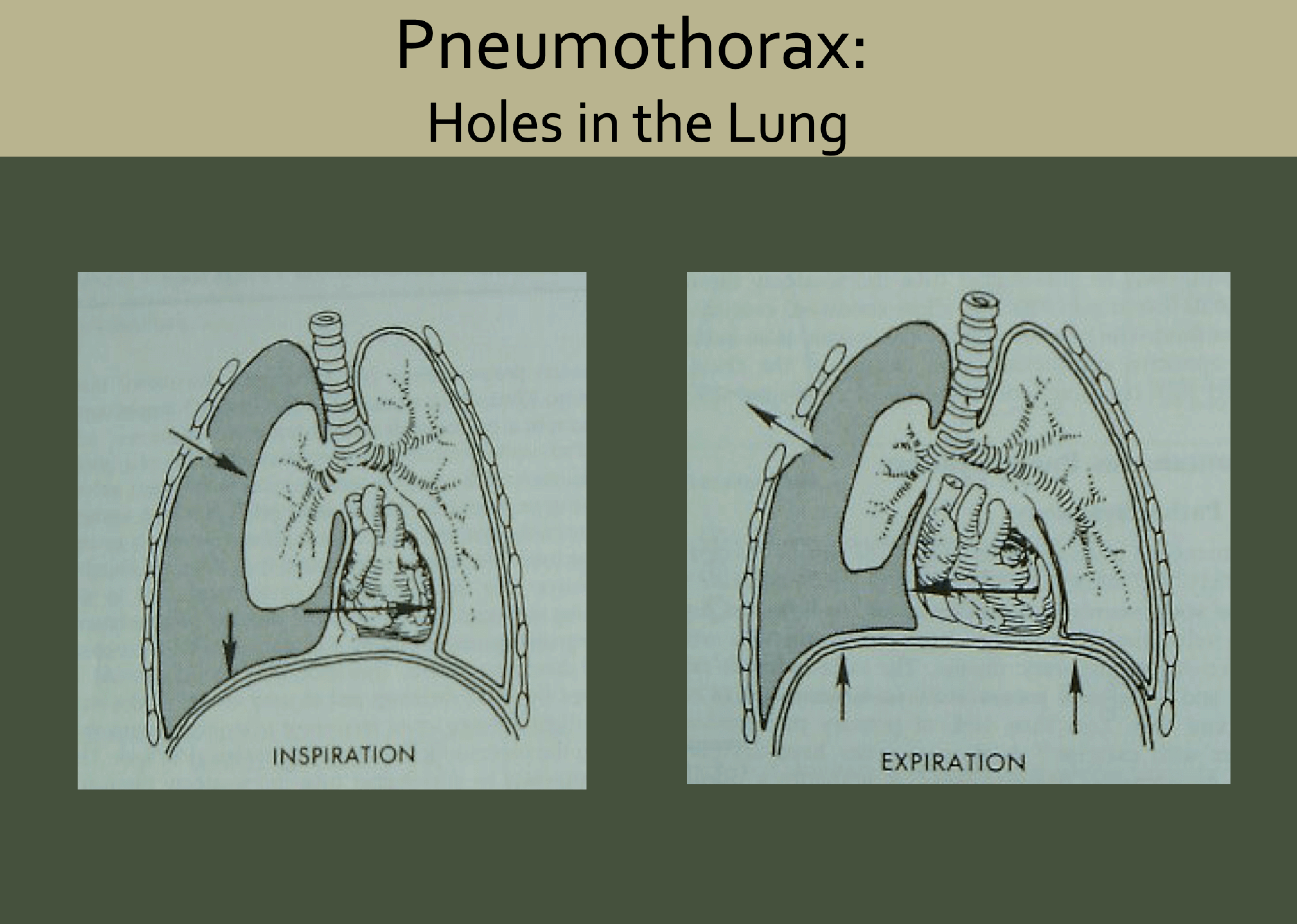 A diagram showing an open pneumothorax showing air going in and out
