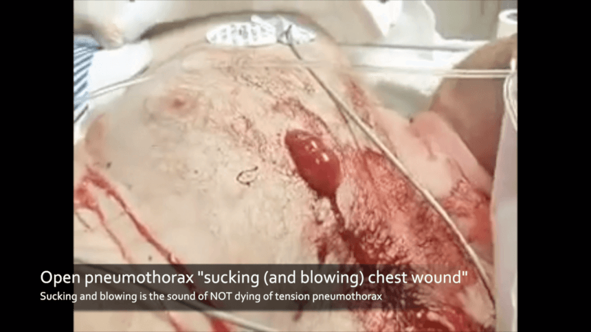 a photo showing a patient with a hole in their chest with blood blowing out of the hole with each exhalation. This sucking chest wound also blows, which is a sign of not dying of tension pneumothorax