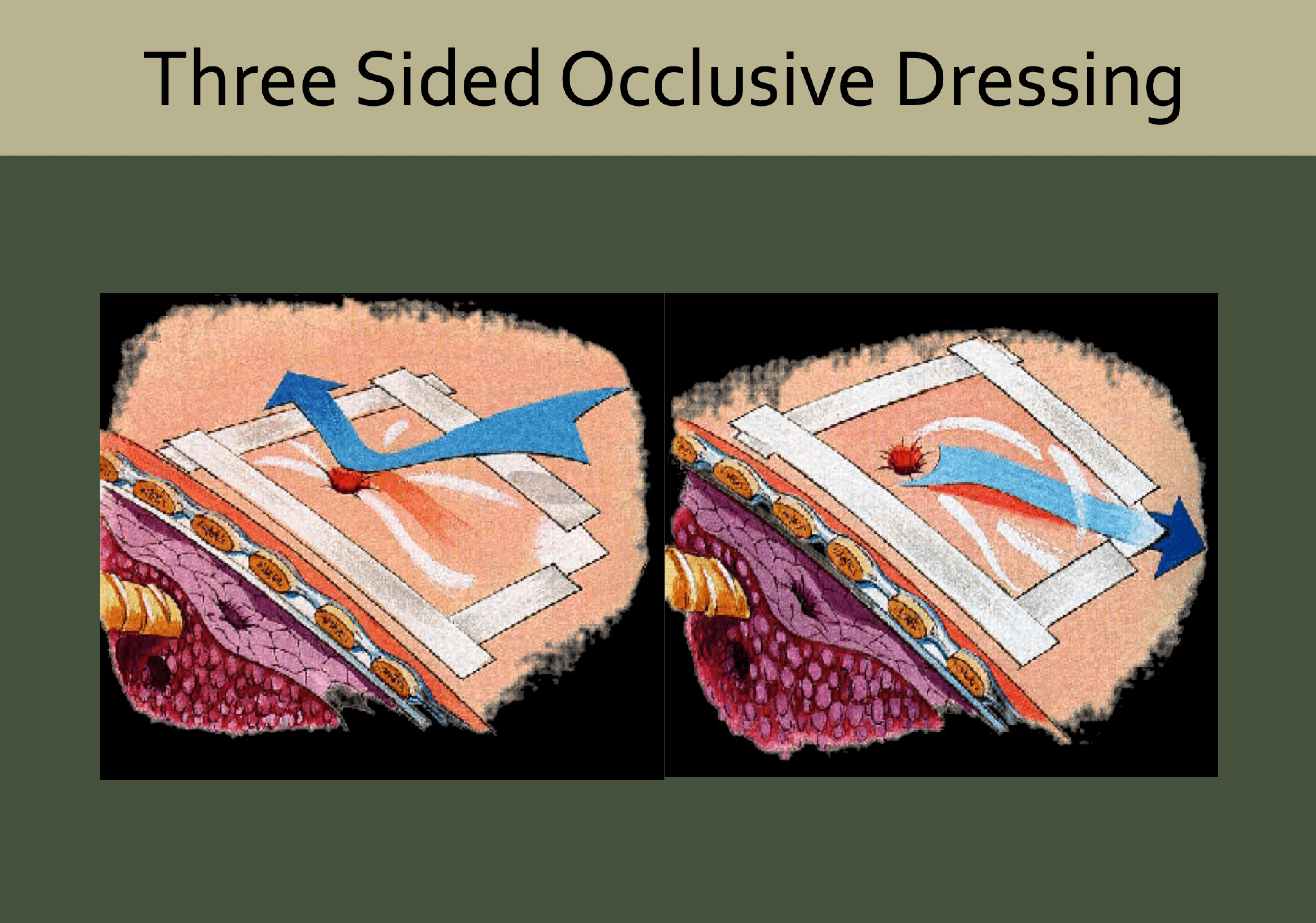 The three sided occlusive dressing is a myth, This diagram shows how it should work but there is no medical evidence to show it does work.