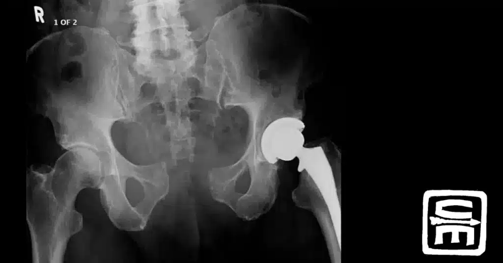An x-ray showing an open book pelvic fracture demonstrating the large gap at the pubic synthesis