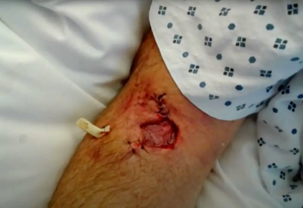 Sea Lion bite to the arm