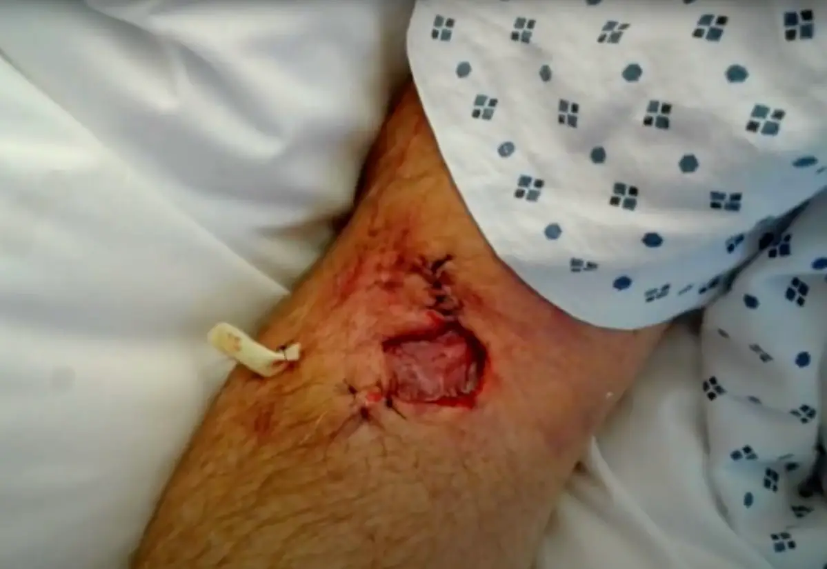 Sea Lion bite to the arm