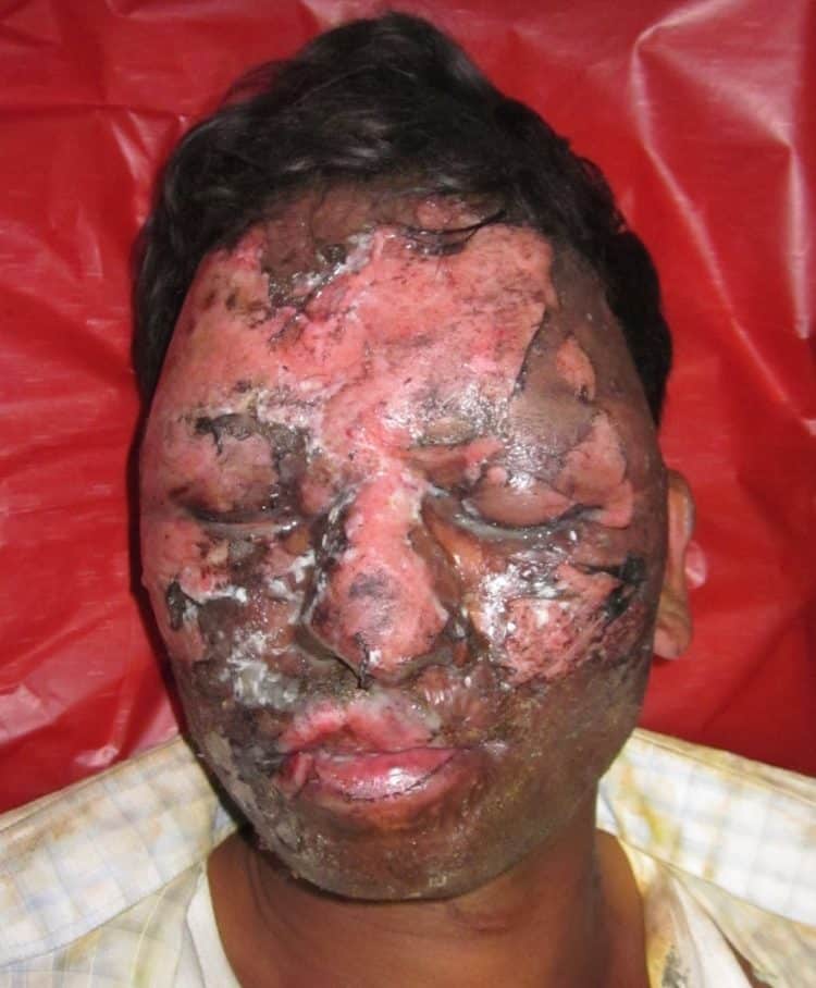 a patient with substantial facial burns, swelling, enlarged lips and nose