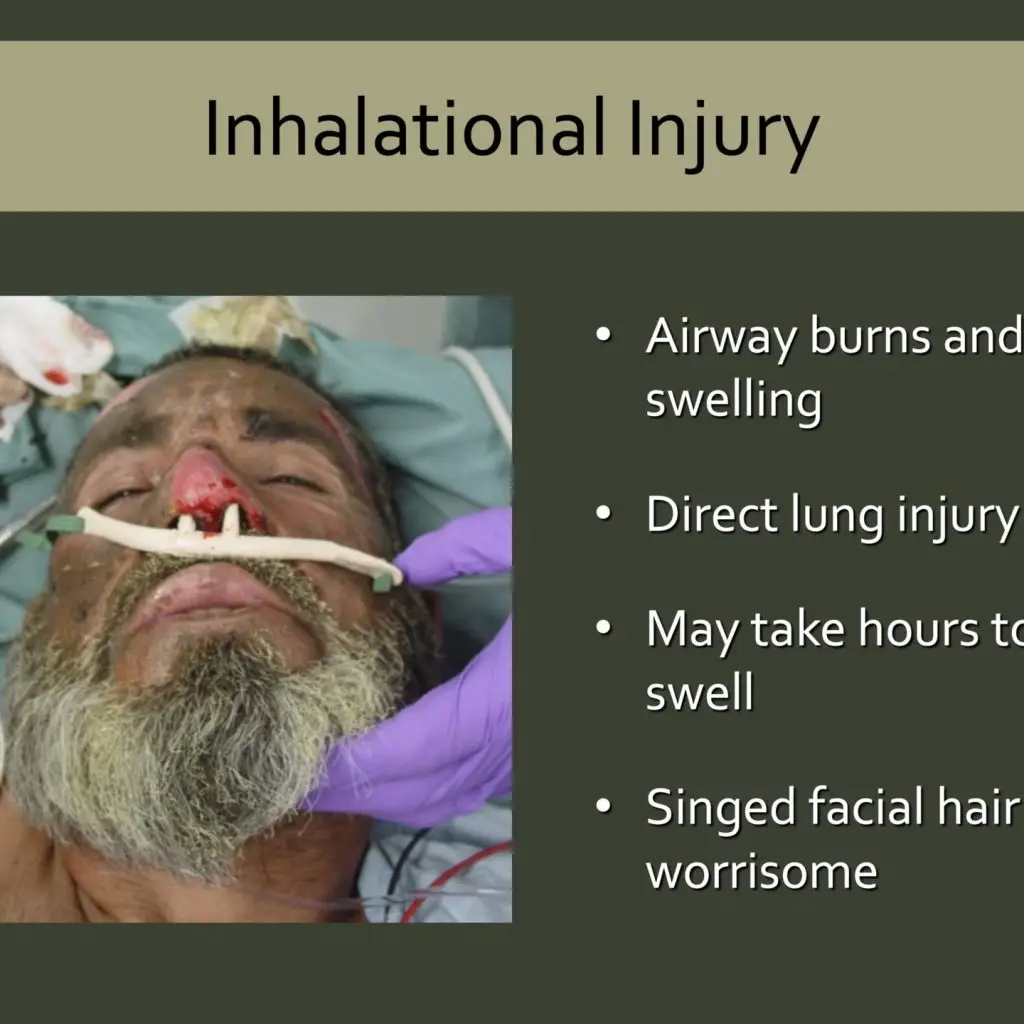 A slide from the Burn section of CM online courses, including issues for inhalation, showing a photo of a burn victim on O2