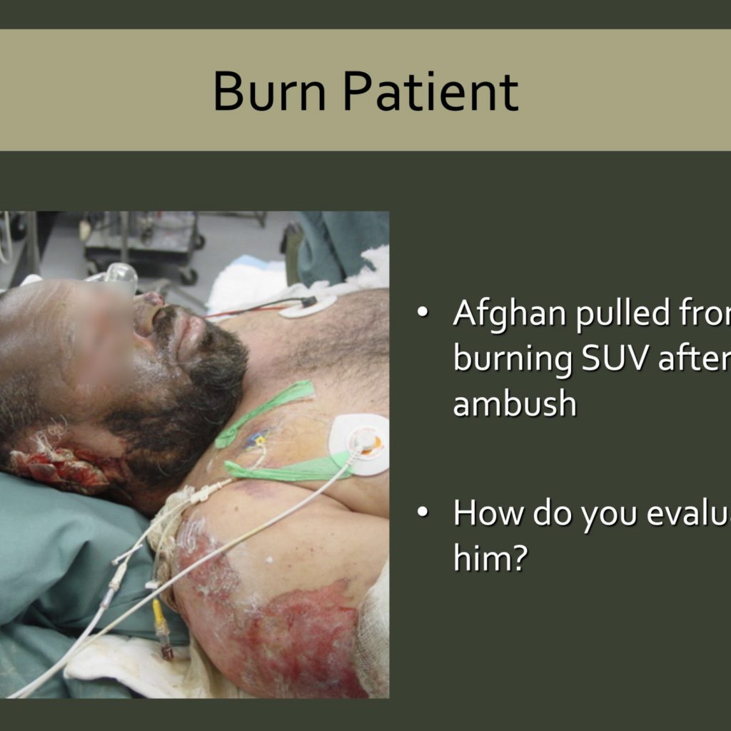 An Afghan is pulled from a burning SUV lays on a stretcher with obvious burns to his arms, face and ears