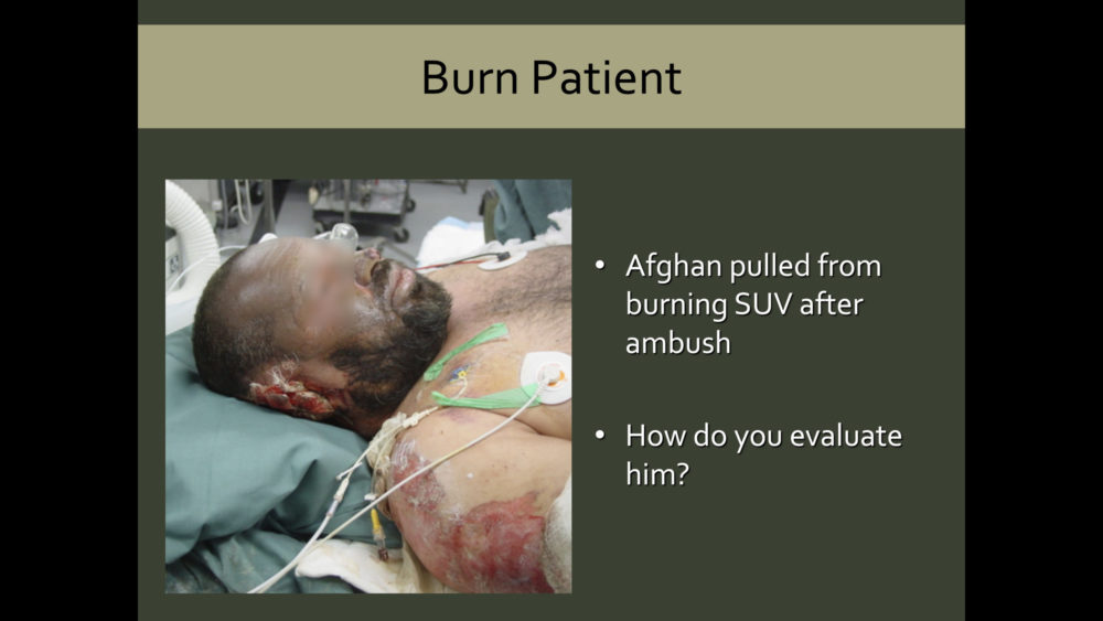 An Afghan is pulled from a burning SUV lays on a stretcher with obvious burns to his arms, face and ears