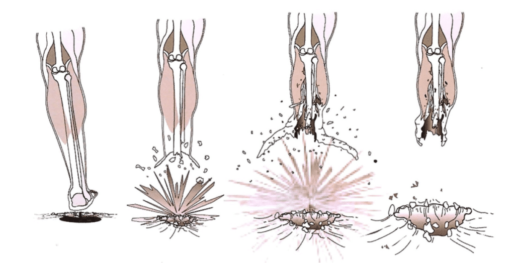 A diagram showing how the landmine umbrella wounding pattern occurs