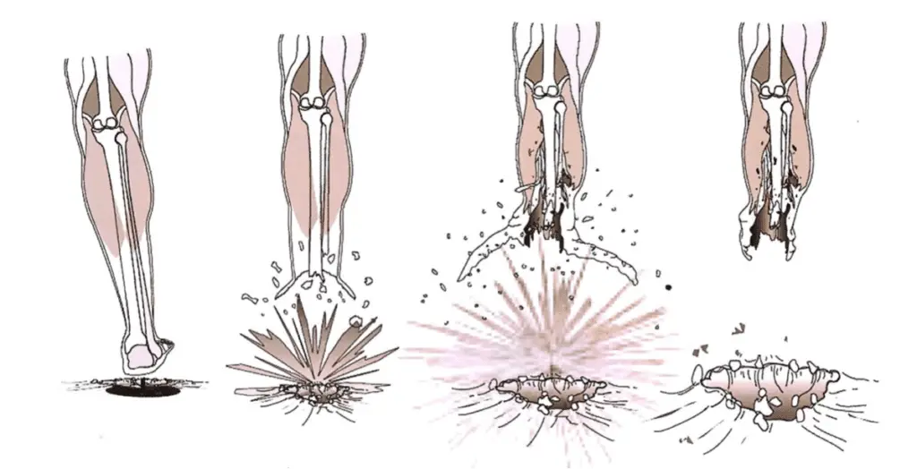 A diagram showing how the landmine umbrella wounding pattern occurs