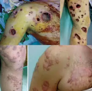 Al Barqouni LN, Skaik SI, Shaban NR, Barqouni N. White phosphorus burn. Lancet. 2010 Jul 3;376(9734):68. 18-year-old male with white phosphorous burns from an artillery shell detonation. Photo A and B are during initial care. C and D after 16 months follow up.