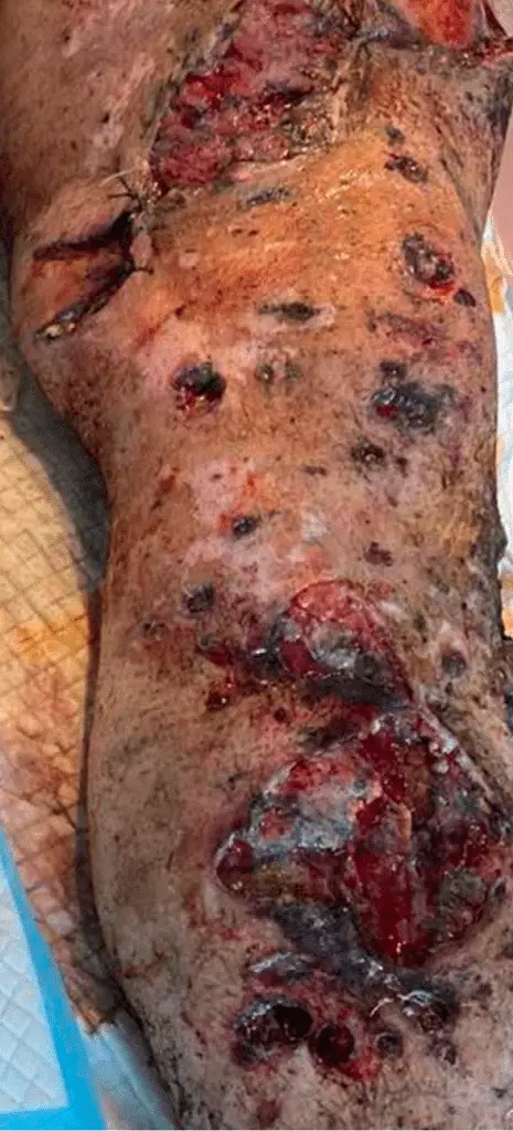 Cavity burn lesions on the left thigh of an Armenian soldier during the 2020 Nagorno-Karabakh war. Brutyan S, Babayan K, Barseghyan N, Petrosyan V, Knipper P, Bégué T, Khachatryan L, Khonsari RH. Evidence for chemical burns by white phosphorus in Armenian soldiers during the 2020 Nagorno-Karabakh war. Injury. 2021 Apr;52(4):1100-1101.