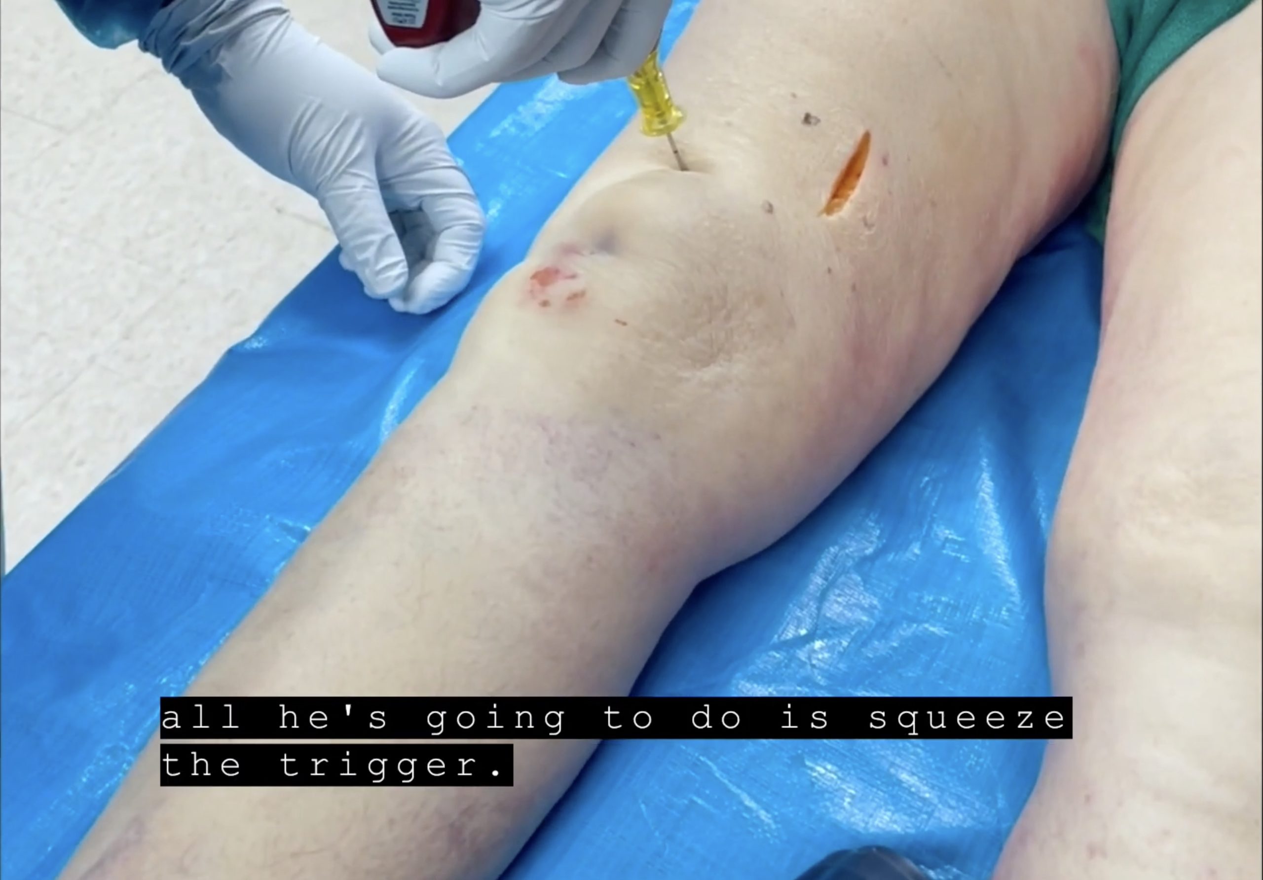 A still photo from a video demonstrating proper placment to insert an IO into a femur