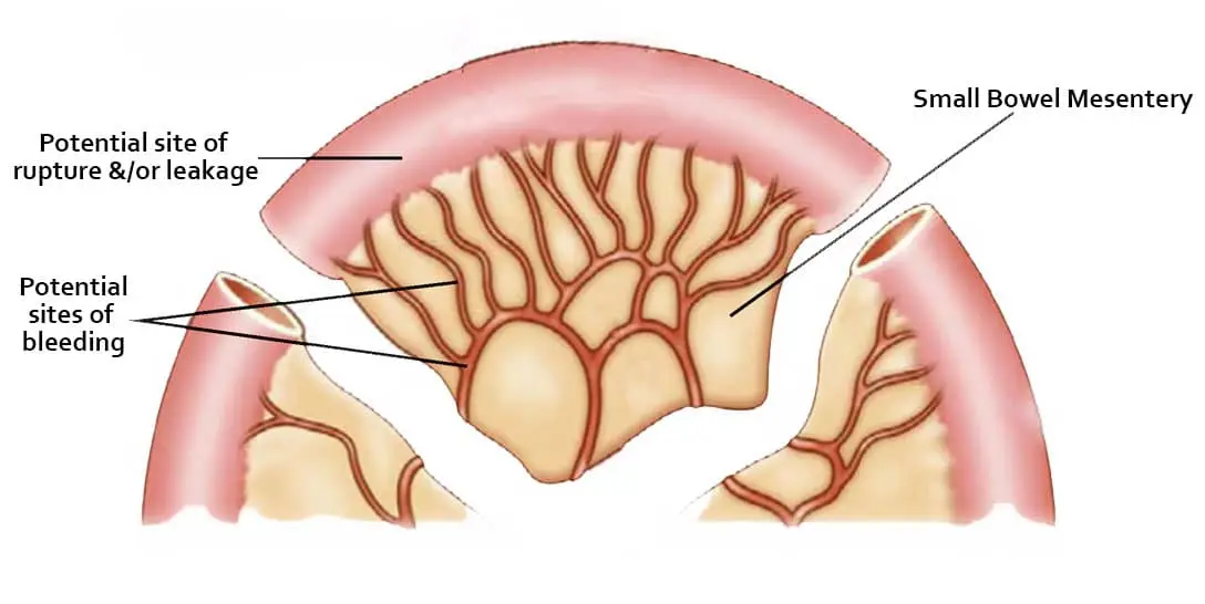 A medical cartoon of the mesentery of the Small Bowel