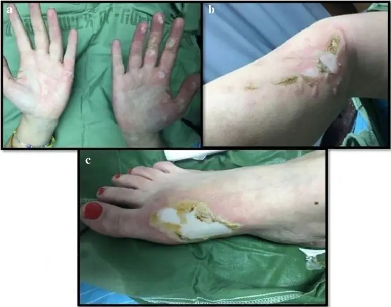 This Israeli woman’s daughter picked up a piece of white phosphorous found on a beach in Tel Aviv. As the white phosphorous dried out it ignited in the woman’s hand. In the process of dropping it, it contacted her calf, and ultimately landed on her socked foot which caught fire. She extinguished the flames in the bathroom shower. She had 0.5% TBSA partial thickness burns of both hands, 1% TBSA partial thickness burns to the calf, and 0.5% TBSA full thickness burns to her foot. She manifested no electrolyte abnormalities, nor organ dysfunction.