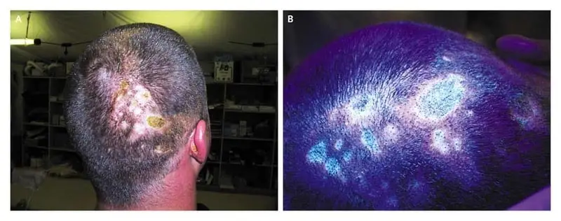 Scalp of another 18-year-old with White Phosphorous burns to his scalp. Apparently, as his bandages were removed the wound began to smoke. Photo on the right fluoresces with ultraviolet light (Woods lamp). Conner JC, Bebarta VS. Images in clinical medicine. White phosphorus dermal burns. N Engl J Med. 2007 Oct 11;357(15):1530.