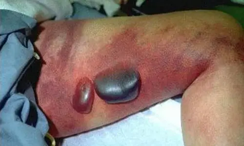 Image of bruised inner though with large blood blisters surrounded by a patchy red almost purple rash.