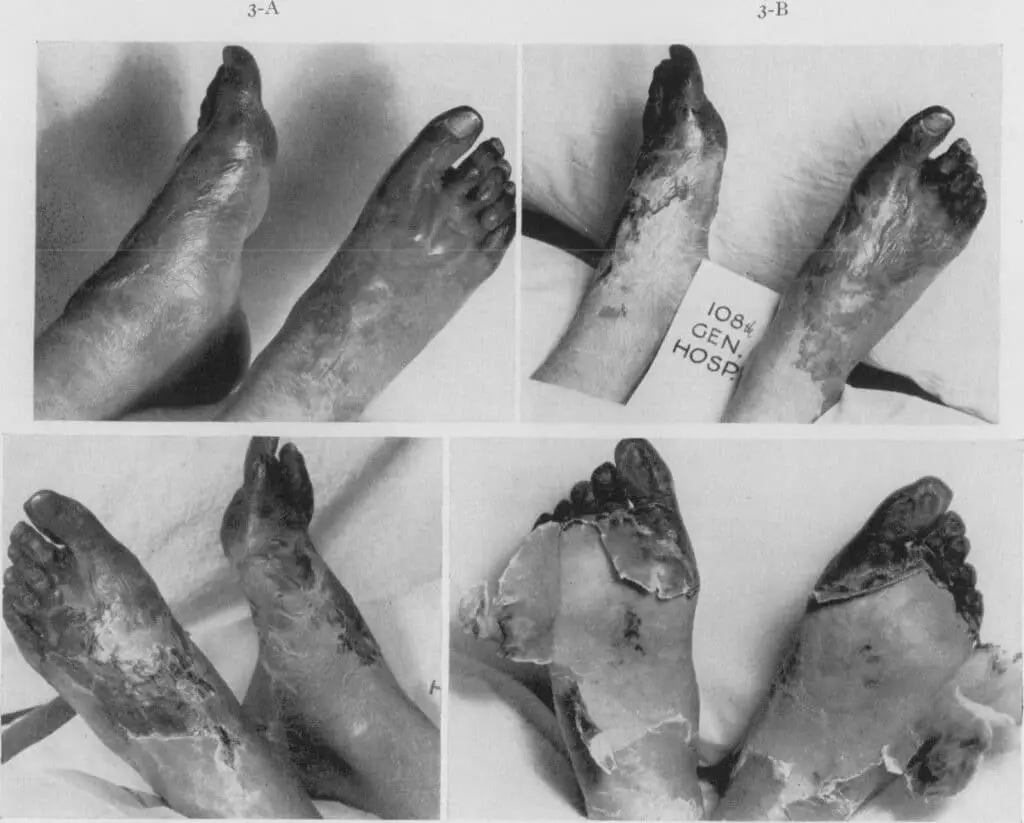Black and white images of trench foot. From toes to heal is a gradient starting with pitch black at the toes.