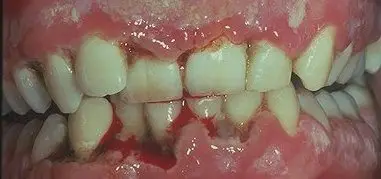 Image of bloody ulcer covered gums and teeth.