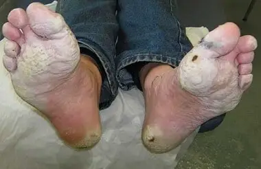 Image of feet effected by trench foot. The pads of the feet have think white dead tissue.