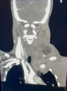 CT angiogram of the neck, demonstrating a Foley catheter in the left neck. Kong V, Ko J, Cheung C, Lee B, Leow P, Thirayan V, Bruce J, Laing G, Khashram M, Clarke D. Foley Catheter Balloon Tamponade for Actively Bleeding Wounds Following Penetrating Neck Injury is an Effective Technique for Controlling Non-Compressible Junctional External Haemorrhage. World J Surg. 2022 May;46(5):1067-1075. doi: 10.1007/s00268-022-06474-4. Epub 2022 Feb 24. PMID: 35211783.