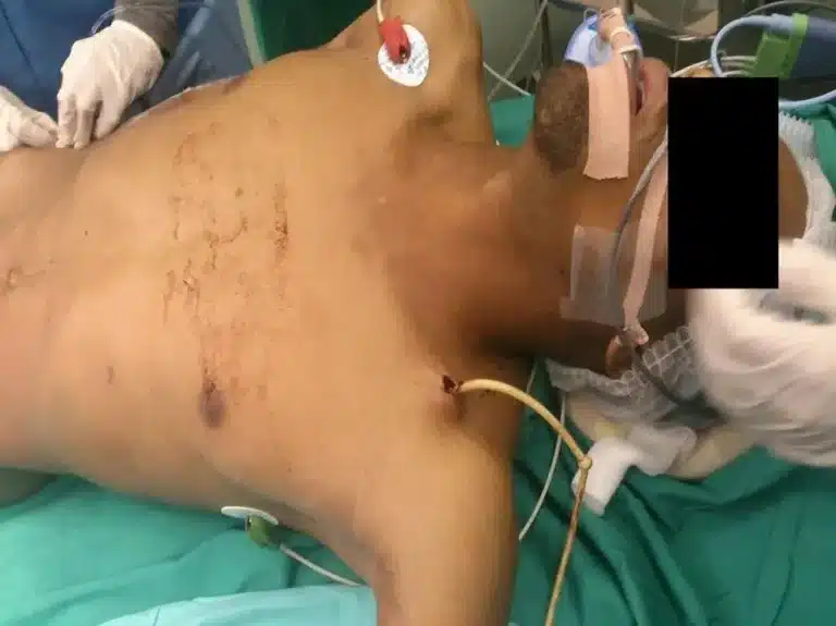 Single FCBT used for penetrating wound to the supraclavicular fossa. Kong V, Ko J, Cheung C, Lee B, Leow P, Thirayan V, Bruce J, Laing G, Khashram M, Clarke D. Foley Catheter Balloon Tamponade for Actively Bleeding Wounds Following Penetrating Neck Injury is an Effective Technique for Controlling Non-Compressible Junctional External Haemorrhage. World J Surg. 2022 May;46(5):1067-1075. doi: 10.1007/s00268-022-06474-4. Epub 2022 Feb 24. PMID: 35211783.