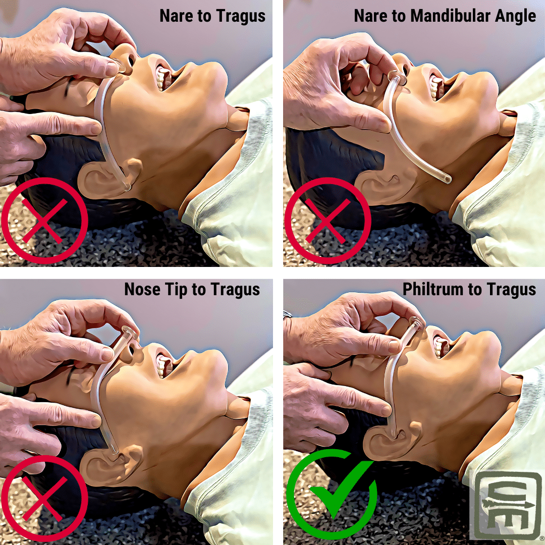 4 diagrams showing the relative measurements of an NPA against different facial anatomical structures