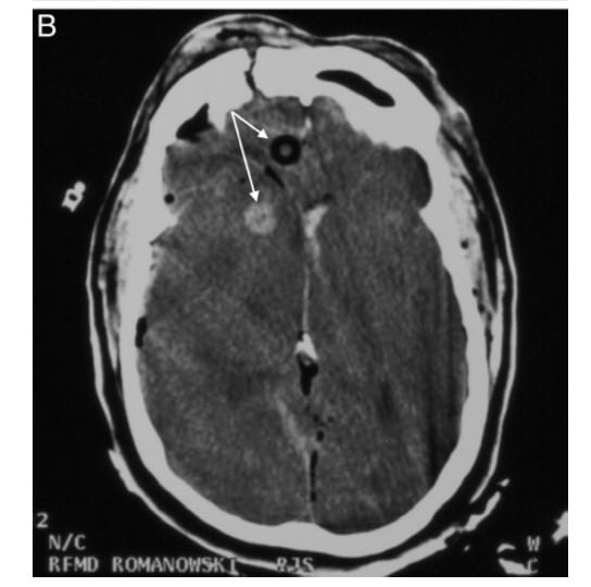 A head CT showing intracranial NPA placement
