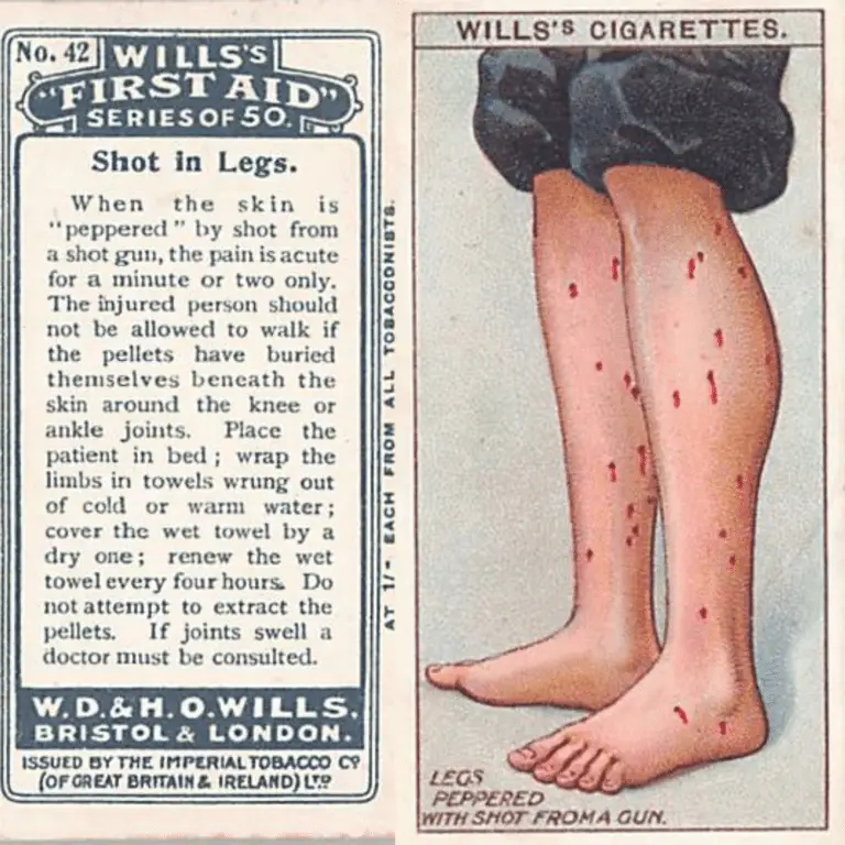 Willlis Cigarette First Aid Cards describing the care of a patient who is "peppered" by shot gun pellets in the legs