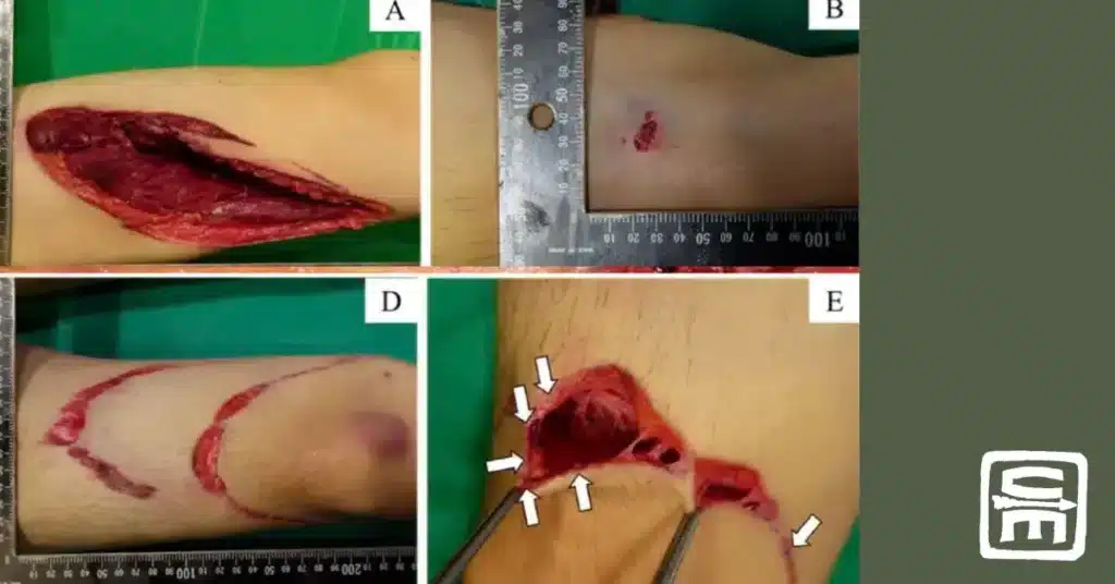 Four photographs showing substantial injuries to various human body parts following contact with industrial high pressure water jet