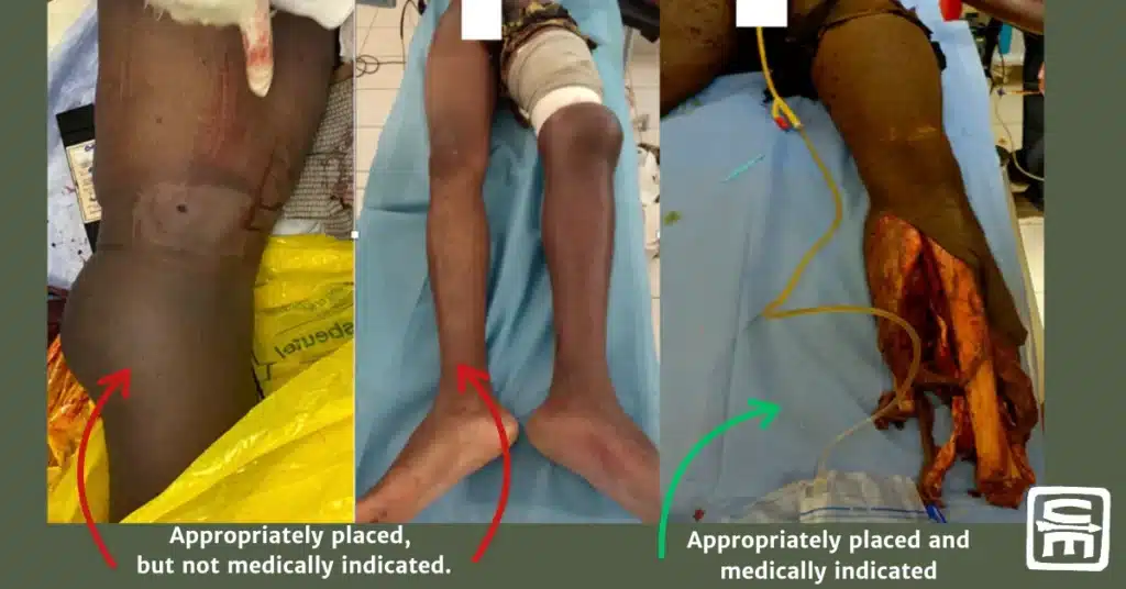 Three photographs showing tourniquets applied to lower extremity wounds, tw of which were not medically necessary