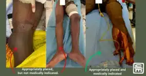 Three photographs showing tourniquets applied to lower extremity wounds, tw of which were not medically necessary