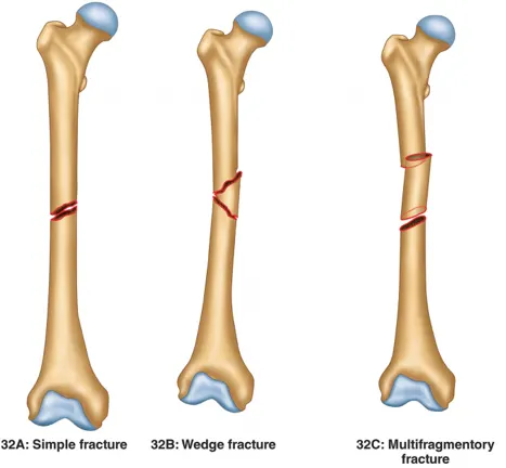 a medical cartoon showing three typical femur fractures