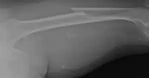 An X-ray showing a femur fracture
