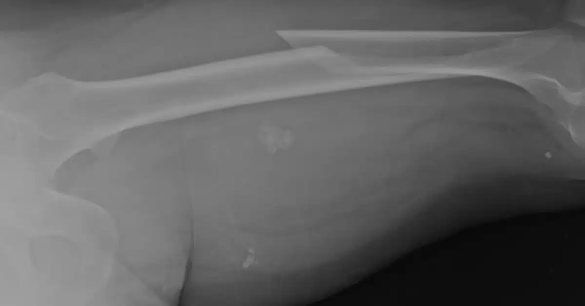 An X-ray showing a femur fracture